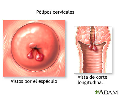 Pólipos cervicales