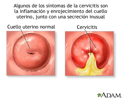 Cervicitis