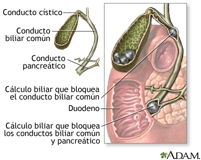 Coledocolitiasis