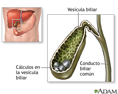 Colelitiasis