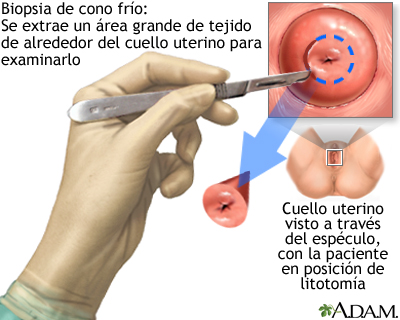 Biopsia de cono frío