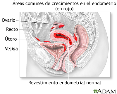 Endometriosis