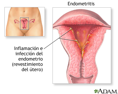 Endometritis