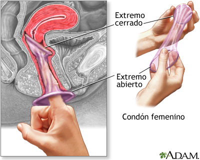 El condón femenino