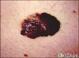 Cáncer de piel o melanoma: lesión oscura saliente