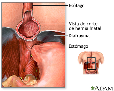 Hernia hiatal