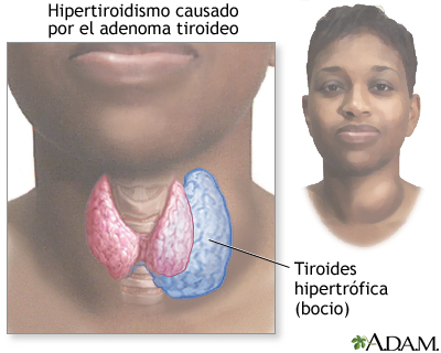 Hipertiroidismo