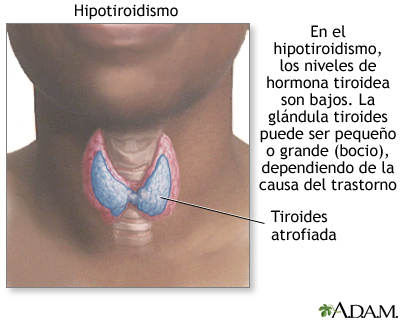 Hipotiroidismo