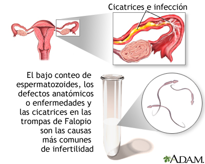 Infertilidad primaria