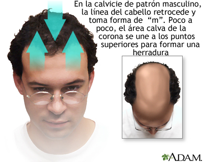 Calvicie de patrón masculino