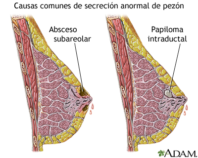 Secreción anormal del pezón