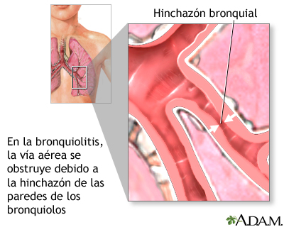 Bronquiolitis