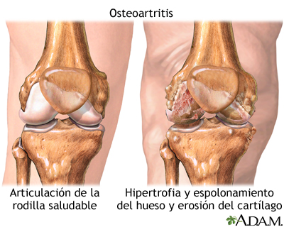 Osteoartritis