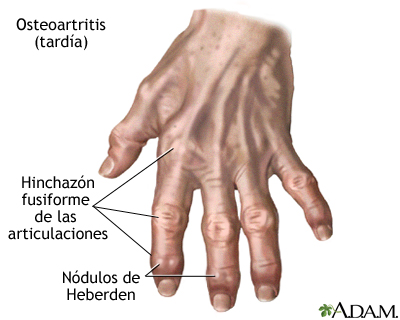 Osteoartritis