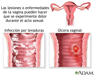 Causas de relaciones sexuales dolorosas