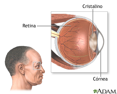 Retinitis por CMV