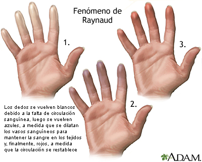 Fenómeno de Raynaud