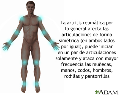 Artritis reumatoide