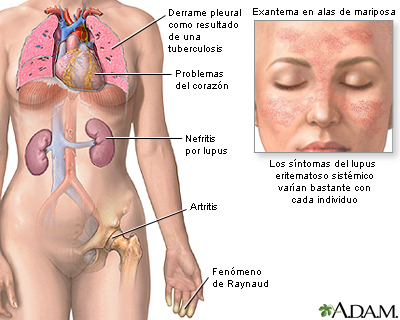 Lupus eritematoso sistémico