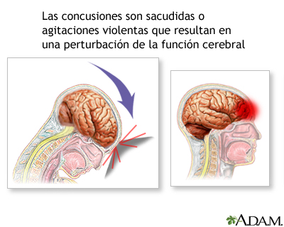 Concusión