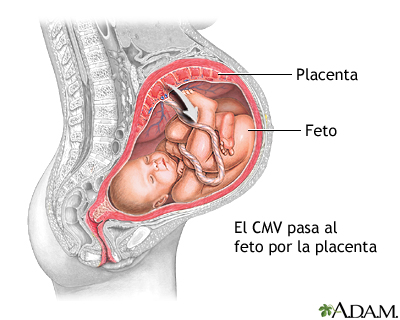 Citomegalovirus congénito