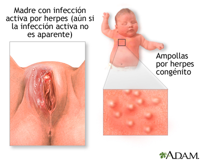 Herpes congénito