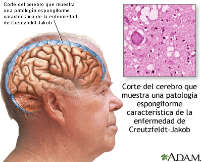 Enfermedad de Creutzfeldt-Jakob
