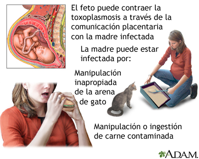 Toxoplasmosis congénita