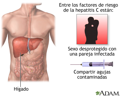 Hepatitis C