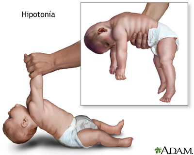 Hipotonia