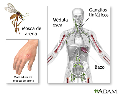 Leishmaniasis