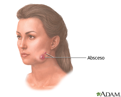 Actinomicosis (mandíbula hinchada)