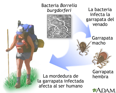 Enfermedad de Lyme