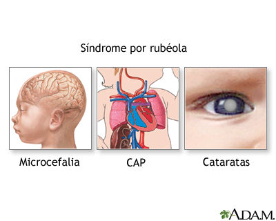 Síndrome de la rubéola