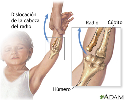 Lesión de la cabeza radial