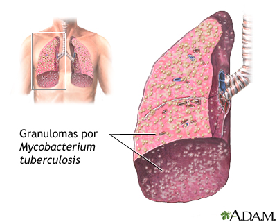 Tuberculosis miliar