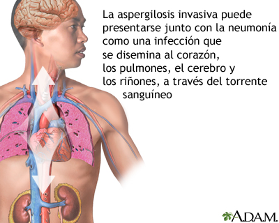 Aspergilosis pulmonar