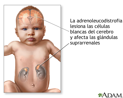 Adrenoleucodistrofia neonatal