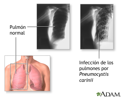 Neumocistosis