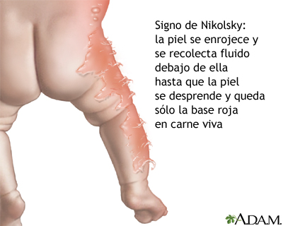 Signo de Nikolsky