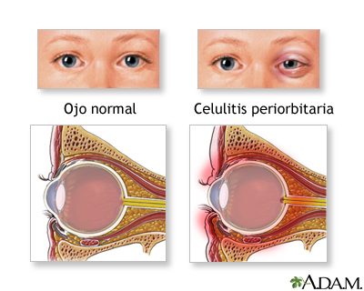 Celulitis periorbital