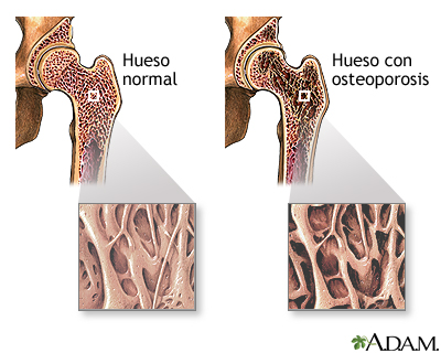 Osteoporosis