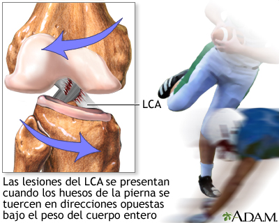 Lesión del LCA