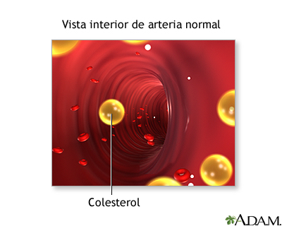 Desgarro arterial en la arteria carótida interna