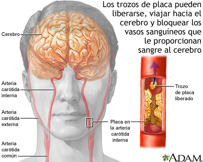 Aterosclerosis de la arteria carótida interna