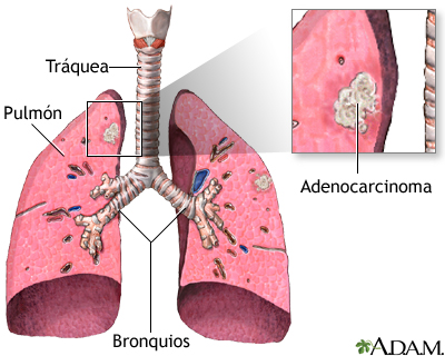 Adenocarcinoma