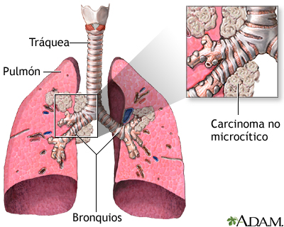 Carcinoma de células grandes