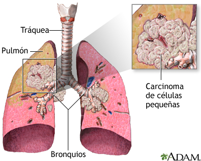 Carcinoma de células pequeñas