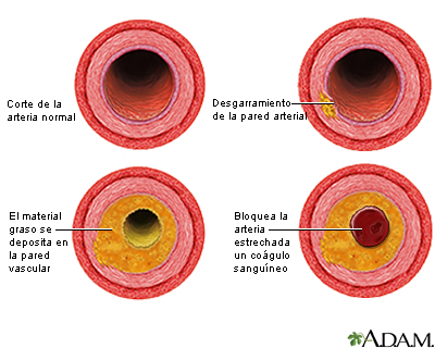 Proceso de evolución de la aterosclerosis