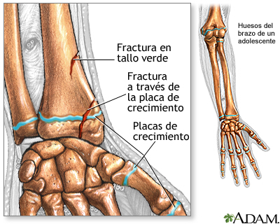 Fracturas a lo largo de una placa de crecimiento